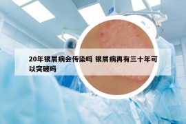 20年銀屑病會(huì)傳染嗎 銀屑病再有三十年可以突破嗎