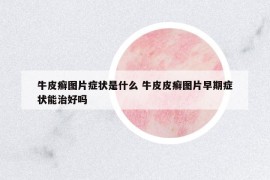 牛皮癬圖片癥狀是什么 牛皮皮癬圖片早期癥狀能治好嗎