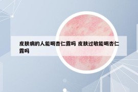 皮膚病的人能喝杏仁露嗎 皮膚過敏能喝杏仁露嗎