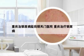 重慶治銀屑病能找朝天門醫(yī)院 重慶治療銀屑病