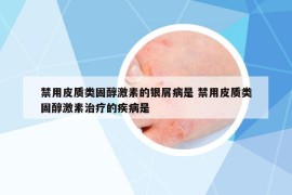 禁用皮質(zhì)類固醇激素的銀屑病是 禁用皮質(zhì)類固醇激素治療的疾病是