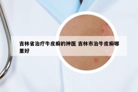 吉林省治療牛皮癬的神醫(yī) 吉林市治牛皮癬哪里好