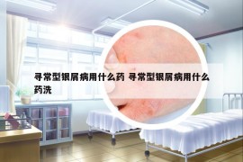 尋常型銀屑病用什么藥 尋常型銀屑病用什么藥洗