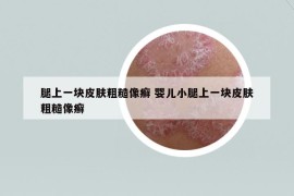 腿上一塊皮膚粗糙像癬 嬰兒小腿上一塊皮膚粗糙像癬