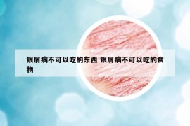 銀屑病不可以吃的東西 銀屑病不可以吃的食物