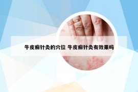 牛皮癬針灸的穴位 牛皮癬針灸有效果嗎