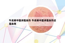 牛皮癬中醫(yī)講是血熱 牛皮癬中醫(yī)講是血熱還是血寒