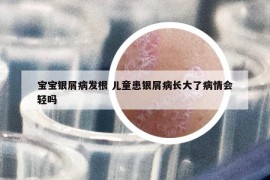 寶寶銀屑病發(fā)根 兒童患銀屑病長(zhǎng)大了病情會(huì)輕嗎