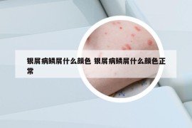 銀屑病鱗屑什么顏色 銀屑病鱗屑什么顏色正常