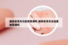 扁挑體發(fā)炎引起銀屑病嗎 扁桃體發(fā)炎會加重銀屑病嗎