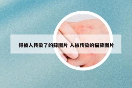 得被人傳染了的蘚圖片 人被傳染的貓?zhí)\圖片