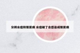 分辨水痘和銀屑病 水痘破了會(huì)感染成銀屑病