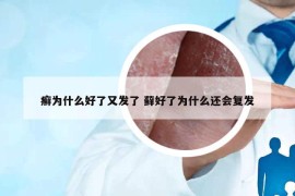 癬為什么好了又發(fā)了 蘚好了為什么還會(huì)復(fù)發(fā)