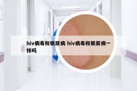 hiv病毒和銀屑病 hiv病毒和銀屑病一樣嗎