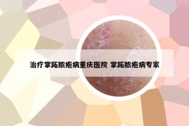 治療掌跖膿皰病重慶醫(yī)院 掌跖膿皰病專家