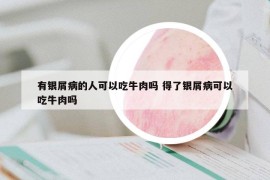 有銀屑病的人可以吃牛肉嗎 得了銀屑病可以吃牛肉嗎