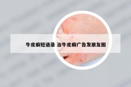 牛皮癬短語錄 治牛皮癬廣告發(fā)朋友圈
