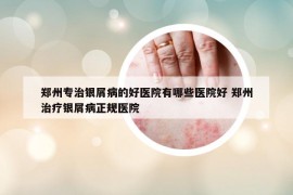 鄭州專治銀屑病的好醫(yī)院有哪些醫(yī)院好 鄭州治療銀屑病正規(guī)醫(yī)院