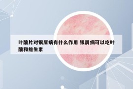 葉酸片對銀屑病有什么作用 銀屑病可以吃葉酸和維生素