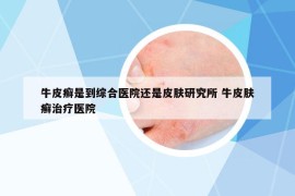 牛皮癬是到綜合醫(yī)院還是皮膚研究所 牛皮膚癬治療醫(yī)院