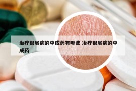 治療銀屑病的中成藥有哪些 冶療銀屑病的中成藥