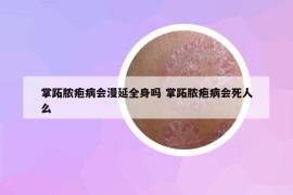 掌跖膿皰病會漫延全身嗎 掌跖膿皰病會死人么