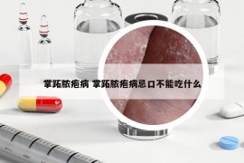 掌跖膿皰病 掌跖膿皰病忌口不能吃什么