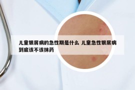 兒童銀屑病的急性期是什么 兒童急性銀屑病到底該不該抹藥