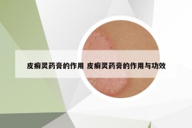 皮癬靈藥膏的作用 皮癬靈藥膏的作用與功效