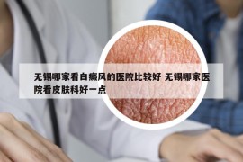 無錫哪家看白癜風(fēng)的醫(yī)院比較好 無錫哪家醫(yī)院看皮膚科好一點
