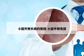 小腿外側(cè)長(zhǎng)癬的原因 小腿外側(cè)有蘚