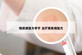 銀屑病復(fù)方季節(jié) 治療銀屑病復(fù)方