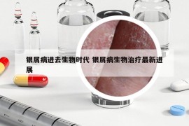 銀屑病進(jìn)去生物時(shí)代 銀屑病生物治療最新進(jìn)展