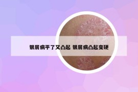 銀屑病平了又凸起 銀屑病凸起變硬