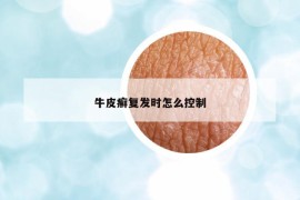 牛皮癬復(fù)發(fā)時怎么控制