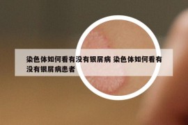 染色體如何看有沒有銀屑病 染色體如何看有沒有銀屑病患者