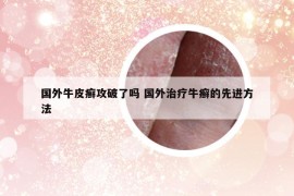 國外牛皮癬攻破了嗎 國外治療牛癬的先進方法