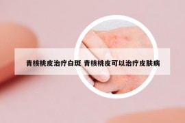 青核桃皮治療白斑 青核桃皮可以治療皮膚病