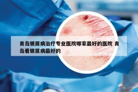 青島銀屑病治療專業(yè)醫(yī)院哪家最好的醫(yī)院 青島看銀屑病最好的