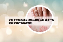 輕度牛皮癬患者可以打新冠疫苗嗎 輕度牛皮膚癬可以打新冠疫苗嗎