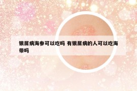 銀屑病海參可以吃嗎 有銀屑病的人可以吃海帶嗎