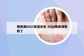銀屑病2023有望攻克 2020銀屑病有救了