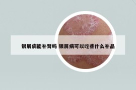 銀屑病能補(bǔ)腎嗎 銀屑病可以吃些什么補(bǔ)品