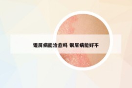 錕屑病能治愈嗎 銀屑病能好不