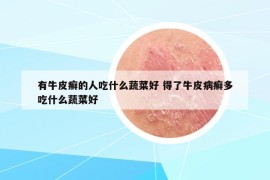 有牛皮癬的人吃什么蔬菜好 得了牛皮病癬多吃什么蔬菜好