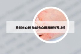 臉部有白斑 臉部有白斑用硼砂可以嗎