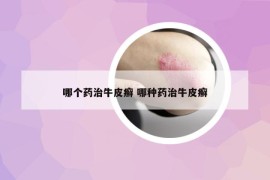 哪個藥治牛皮癬 哪種藥治牛皮癬