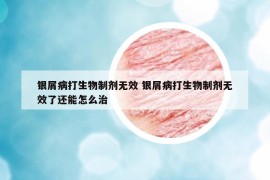 銀屑病打生物制劑無效 銀屑病打生物制劑無效了還能怎么治