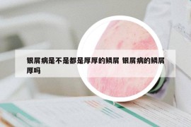 銀屑病是不是都是厚厚的鱗屑 銀屑病的鱗屑厚嗎