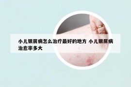 小兒銀屑病怎么治療最好的地方 小兒銀屑病治愈率多大